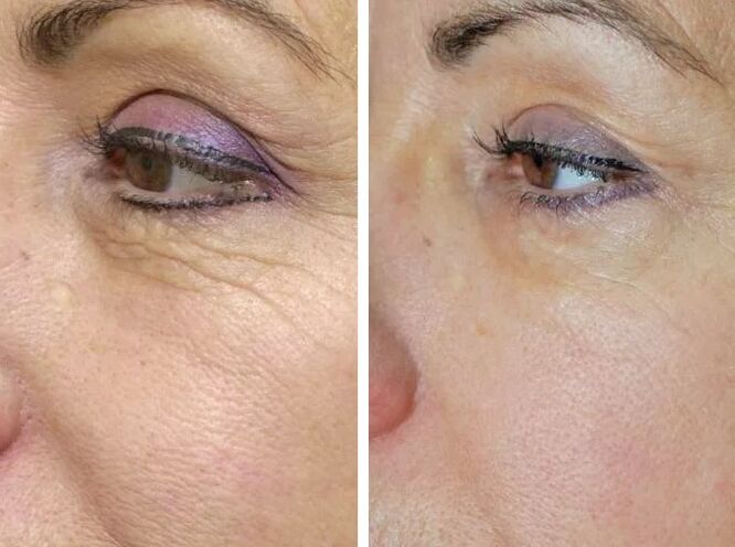 Terénny laser pred a po